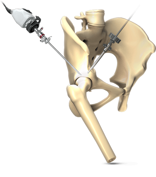 Hip Arthroscopic Surgery