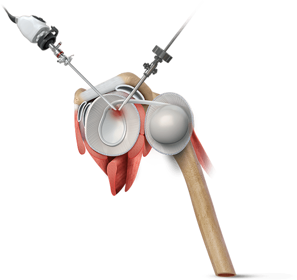 Shoulder Arthroscopy